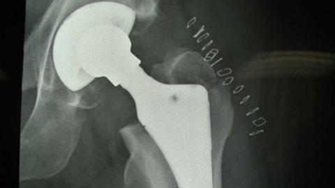 Ein implantiertes Hüftgelenk auf einer Röntgenaufnahme.