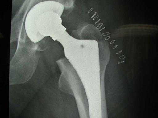 Implantiertes Hüftgelenk auf der Röntgenaufnahme.