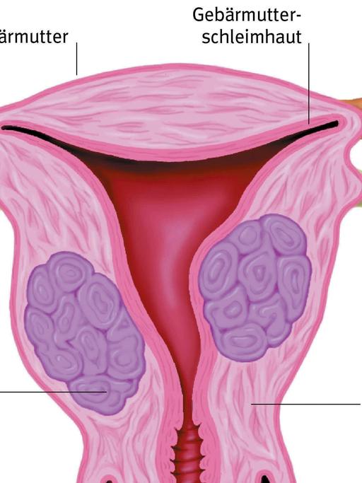 Fortpflanzungsorgane: Gebärmuttermyom
