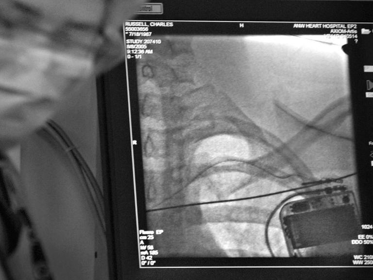Auf einem Monitor ist ein Röntgenbild eines Medtronic-Defibrillators zu sehen, der einem Mann, Charlie Russell, vom Herzchirurgen Adrian Almquist implantiert wird, aufgenommen 2005 in Minneapolis