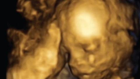 Uterus-Transplantation: 3D-Bild des Fötus auf einer Ultraschallaufnahme in der 18. Schwangerschaftswoche