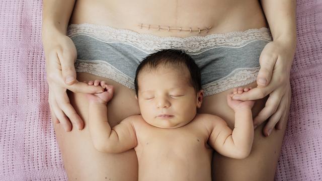 Ein schlafendes Baby liegt auf den Beinen seiner Mutter. Am Bauch der Mutter ist eine Narbe zu sehen.