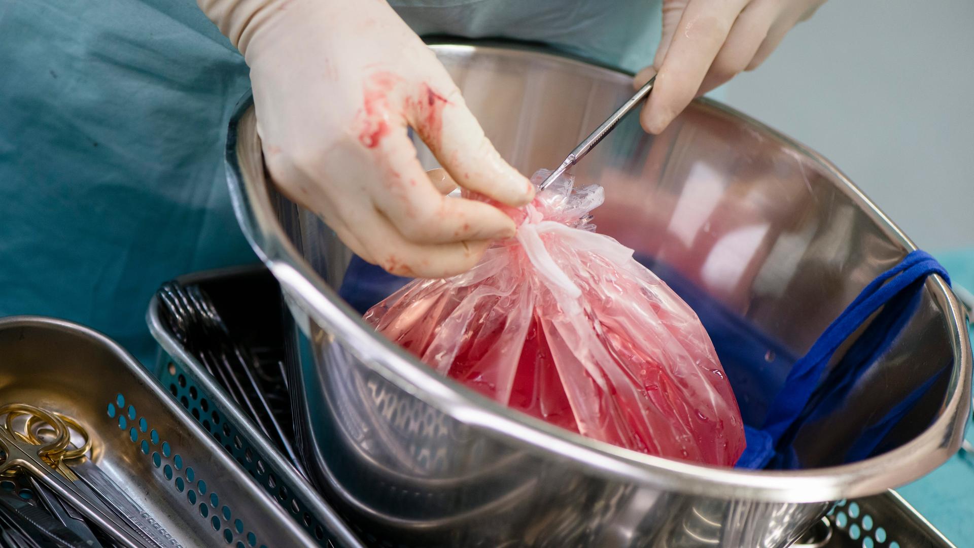 Zwei Hände fassen in eine Schüssel, in der sich eine Leber in einer Plastiktüte befindet. Zwei Hände fassen in eine Schüssel, in der sich eine Leber in einer Plastiktüte befindet.