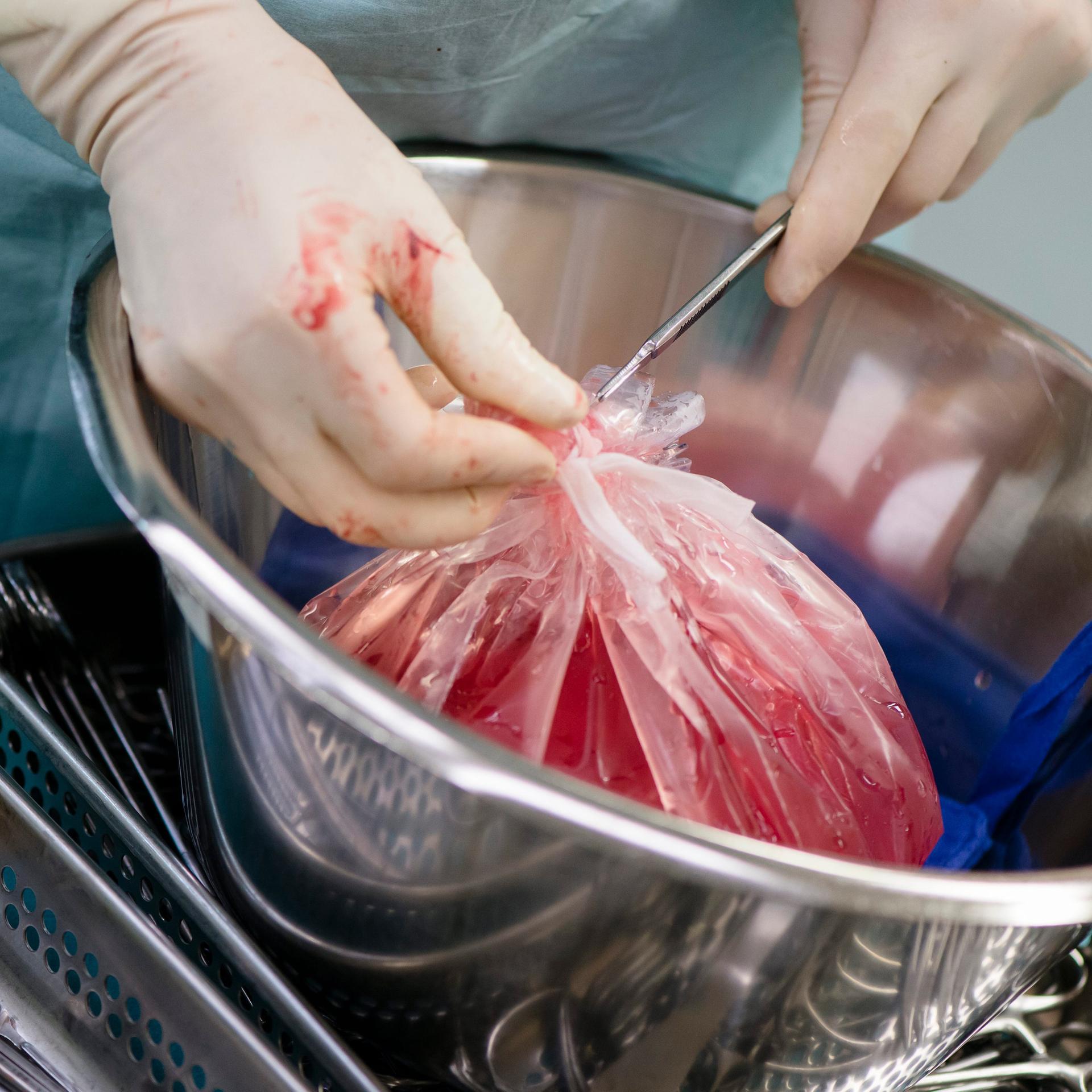 Xenotransplantation - Erstmals wurde einem Menschen eine Schweineleber transplantiert