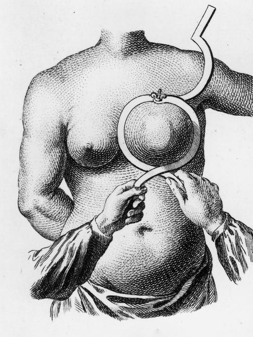 Historische Grafik einer Frau, deren Brust mit einem medizinischen Gerät was an eine Art Ring erinnert, umschlossen wird.