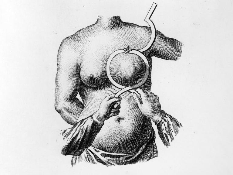 Historische Grafik einer Frau, deren Brust mit einem medizinischen Gerät was an eine Art Ring erinnert, umschlossen wird.