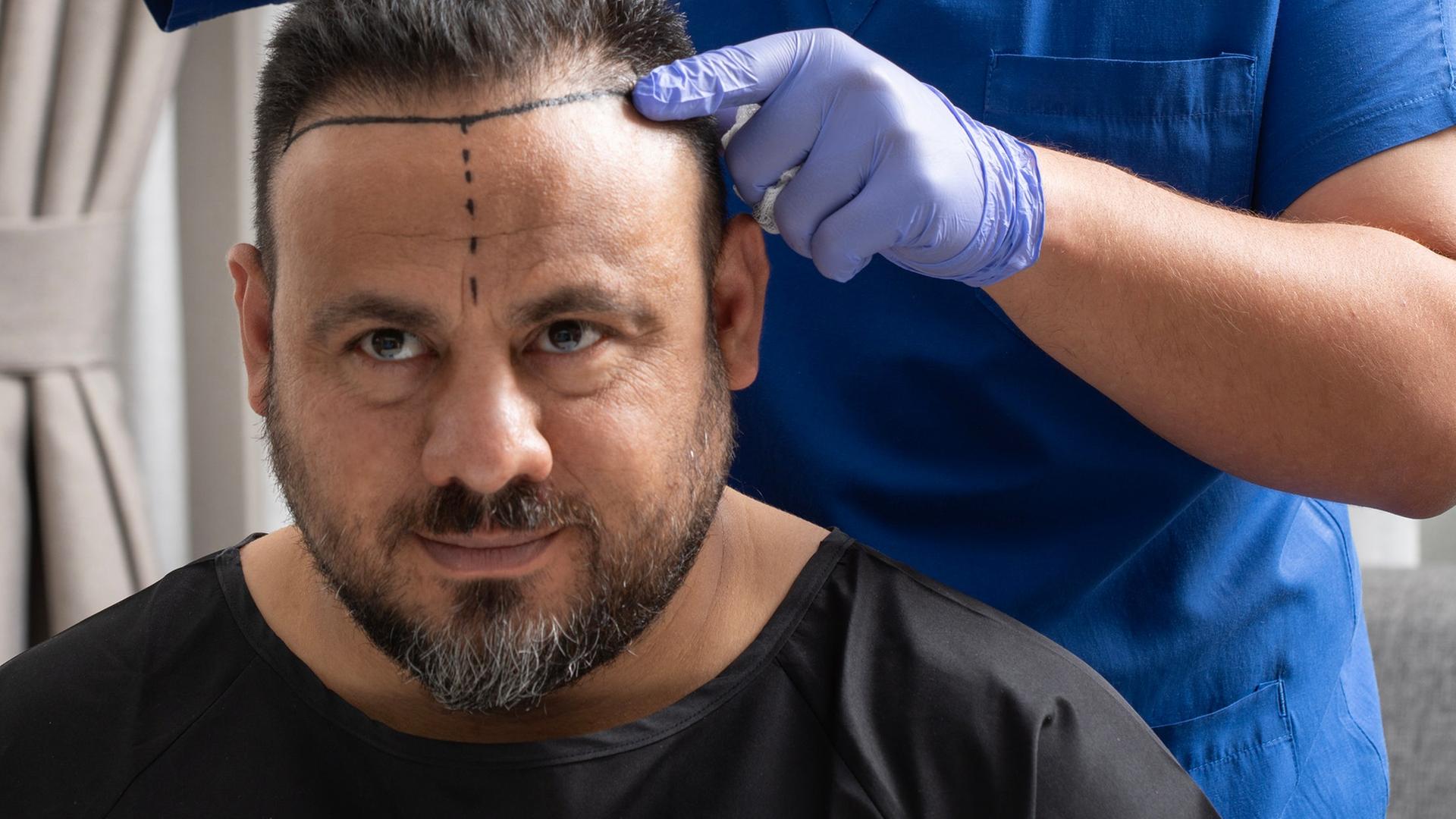 Ein Arzt, der blaue Handschuhe trägt, zeichnet mit einem Stift das Gebiet für die Haartransplantation bei einem Männerkopf ein. 