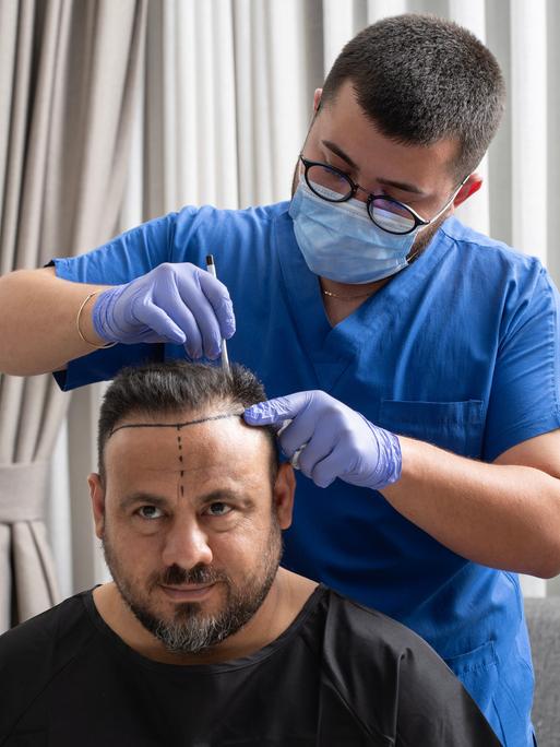 Ein Arzt, der blaue Handschuhe trägt, zeichnet mit einem Stift das Gebiet für die Haartransplantation bei einem Männerkopf ein. 