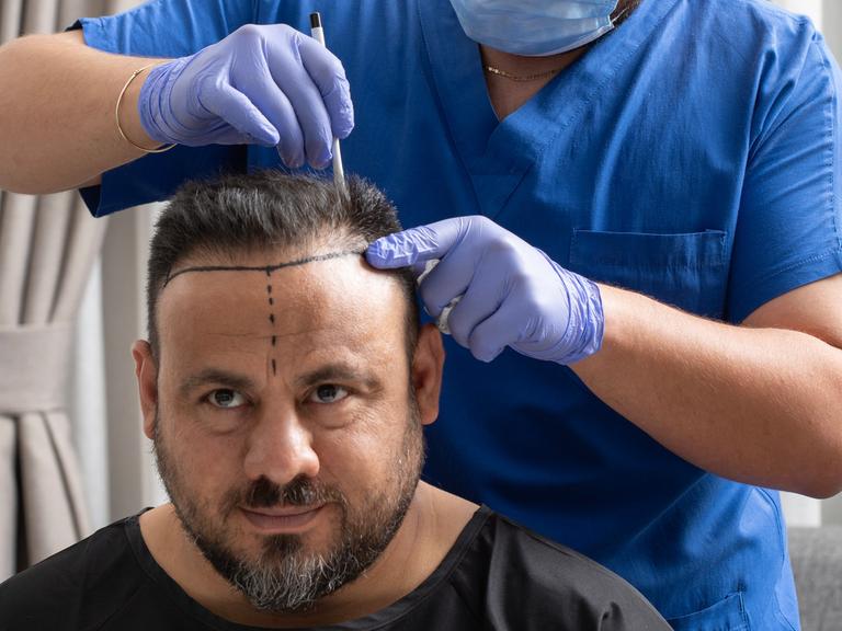 Ein Arzt, der blaue Handschuhe trägt, zeichnet mit einem Stift das Gebiet für die Haartransplantation bei einem Männerkopf ein. 