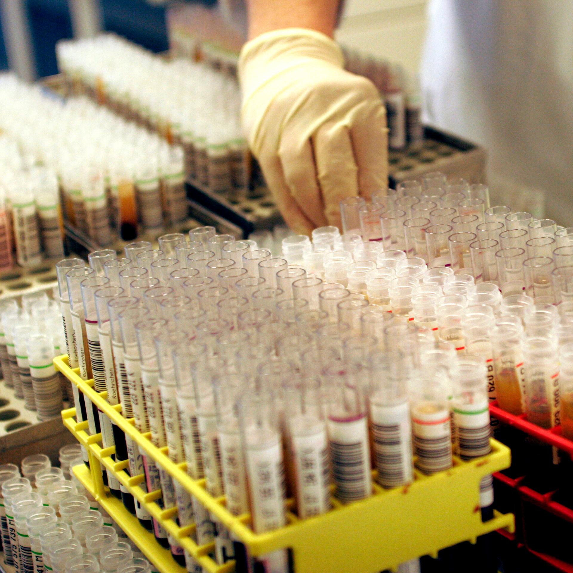Auff einem Labortisch stehen mit Blut gefuellte Analyseröhrchen zur Untersuchung auf ansteckende Krankheiten wie HIV und Syphilis.