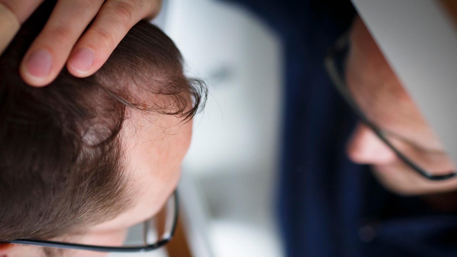 Haarausfall: Ein Mann betrachtet seinen Haaransatz im Spiegel. Haarausfall: Ein Mann betrachtet seinen Haaransatz im Spiegel.