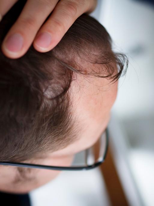 Haarausfall: Ein Mann betrachtet seinen Haaransatz im Spiegel. 