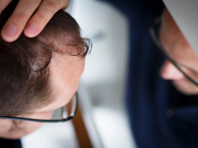 Haarausfall: Ein Mann betrachtet seinen Haaransatz im Spiegel. 