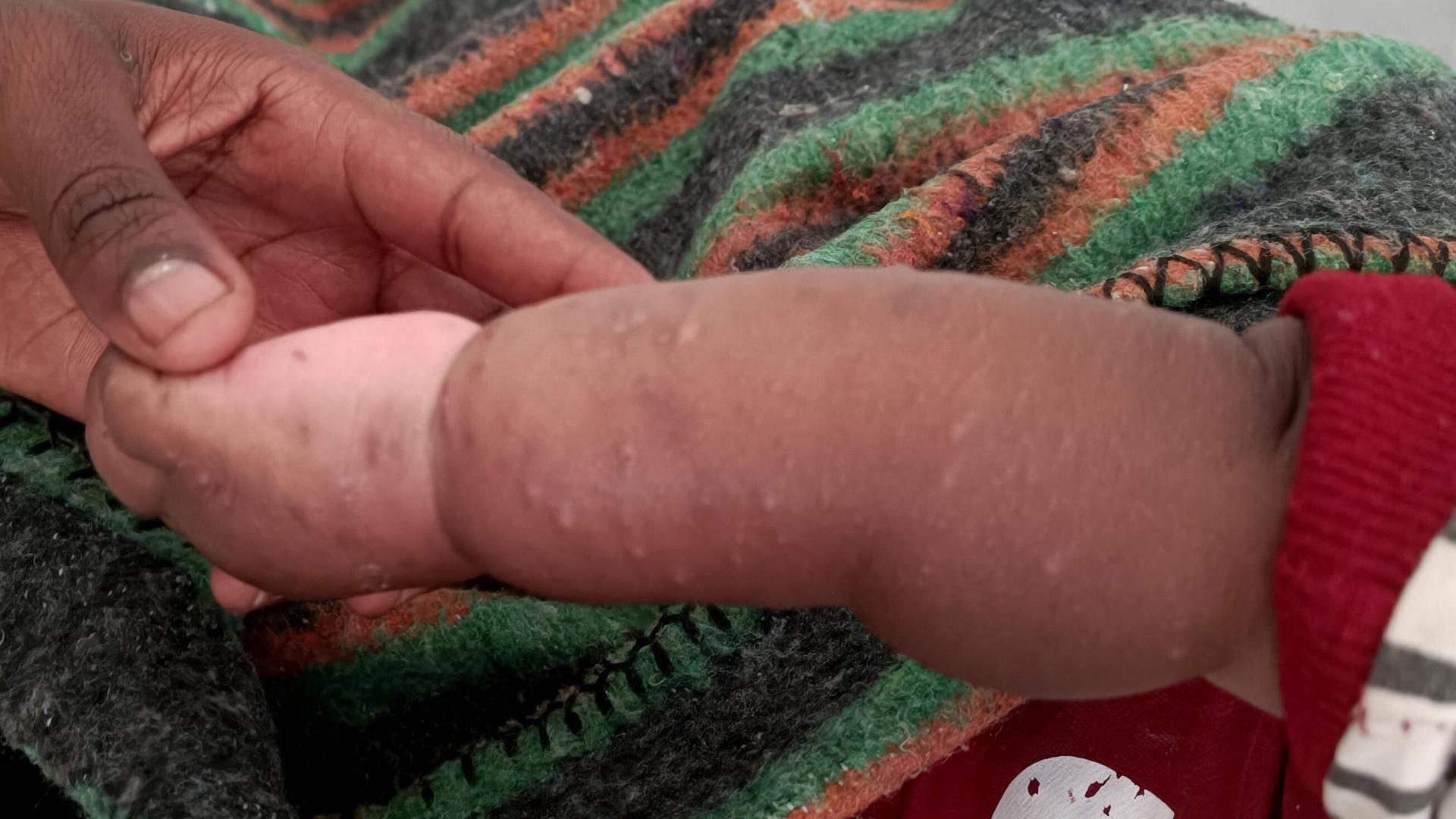 Ein Kinderarm ist bedeckt mit Pocken. Ein Kinderarm ist bedeckt mit Pocken.