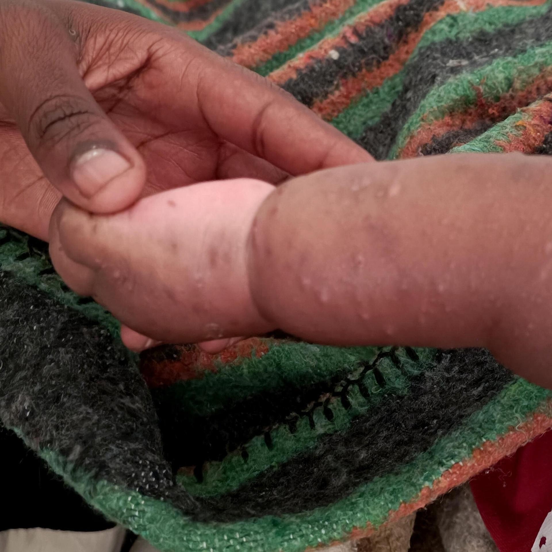 Infektiöse Pocken - MPox in Kongo: Die Lehren aus einem schweren Ausbruch