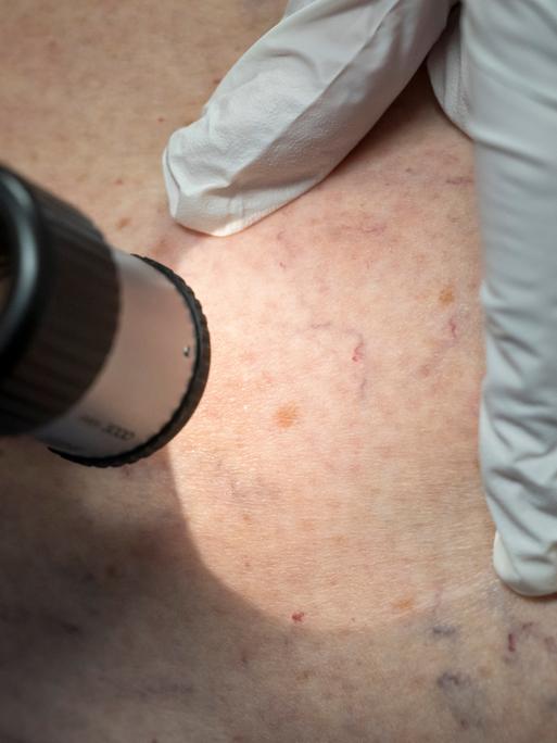 Ein Arzt untersucht in der Praxis die Hautpartie eines Patienten.