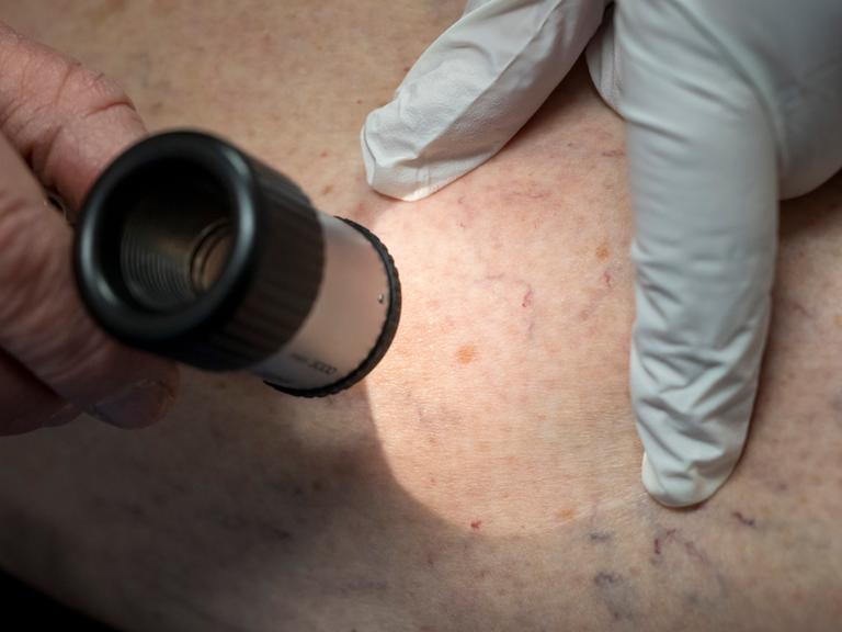 Ein Arzt untersucht in der Praxis die Hautpartie eines Patienten.