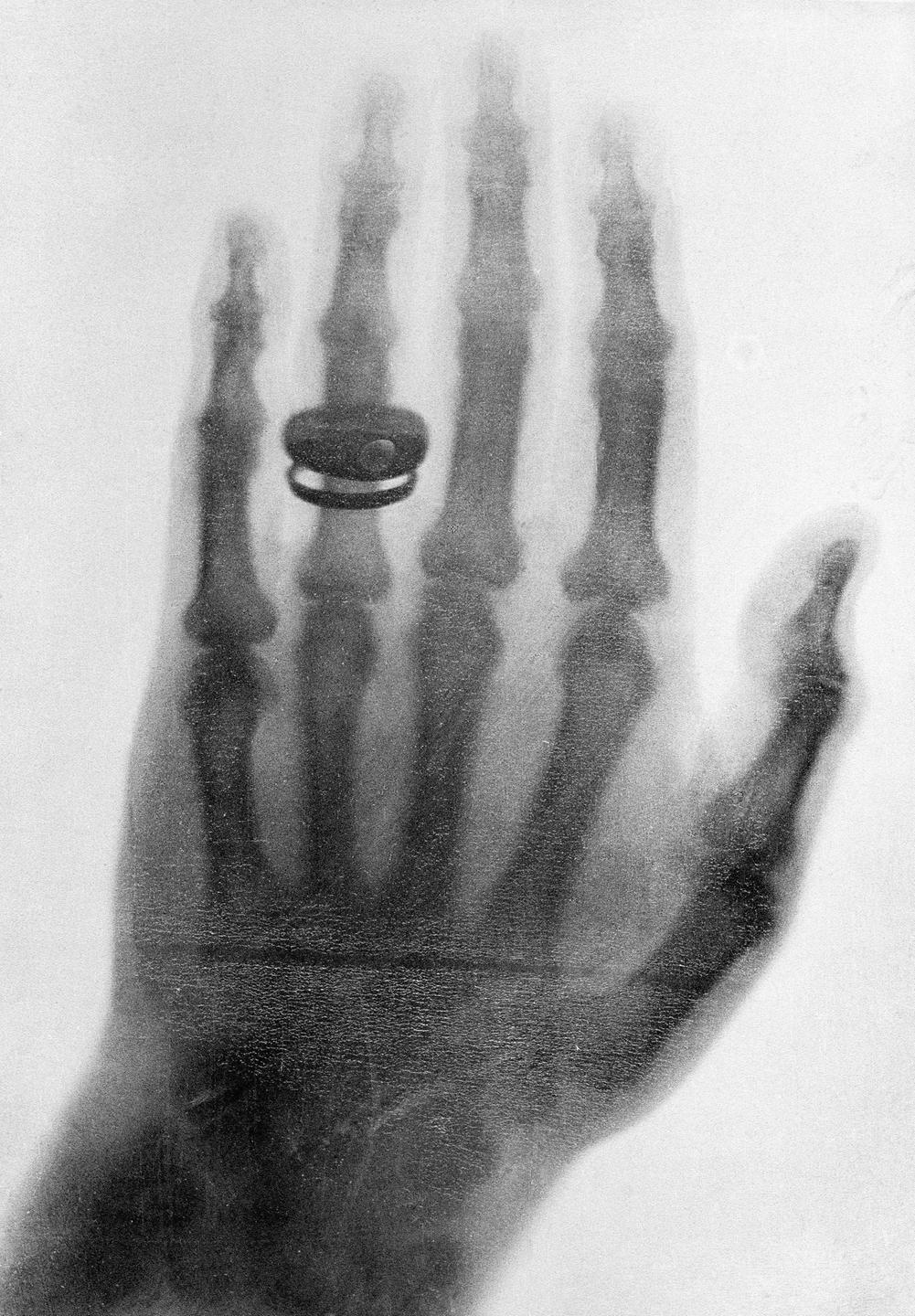 Röntgenbild: Eine der ersten Röntgenaufnahmen, die 1898 von Wilhelm Conrad Röntgen gemacht wurde. Zu sehen ist eine Hand mit einem Ring am Finger.