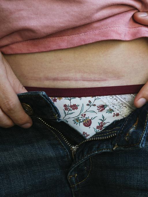 Eine Frau zeigt ihre Kaiserschnittnarbe über der Unterhose bei leicht geöffneter Jeans.