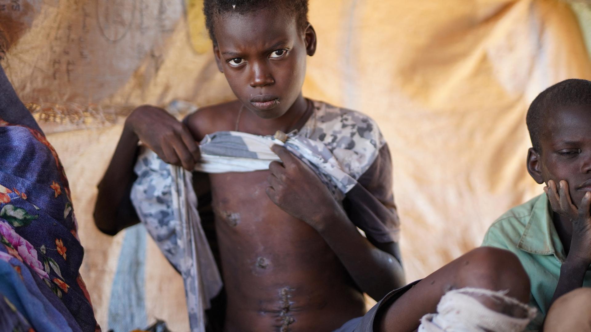Ein Junge hebt sein Shirt hoch und zeigt seine Wunden an Bauch und Oberkörper