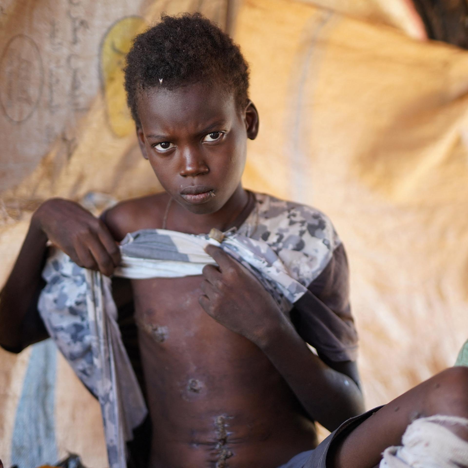 A handout picture released by the International Committee of the Red Cross (ICRC) on November 18, 2025 shows Ibrahim Ismail, who was wounded in an attack on a local market in El-Fasher, showing his scars at a makeshift camp in the city of Tawila sheltering displaced civilians who have fled violence in El-Fasher. The horrific bloodshed in the Sudanese city of El-Fasher is a "stain" on the world, the UN said, urging the international community to act following warnings of crimes against humanity and genocide. Since breaking out in April 2023, the war between Sudan's army and the paramilitary Rapid Support Forces has killed tens of thousands of people, displaced nearly 12 million more and triggered one of the world's worst humanitarian crises. The violence has escalated dramatically in recent weeks, with the RSF seizing control of the key town of El-Fasher in Sudan's western Darfur region after an 18-month siege and reports of atrocities multiplying. (Photo by Mohamed JAMAL / ICRC / AFP) / RESTRICTED TO EDITORIAL USE - MANDATORY CREDIT "AFP PHOTO / ICRC / MOHAMED JAMAL" - HANDOUT - NO MARKETING NO ADVERTISING CAMPAIGNS - DISTRIBUTED AS A SERVICE TO CLIENTS
