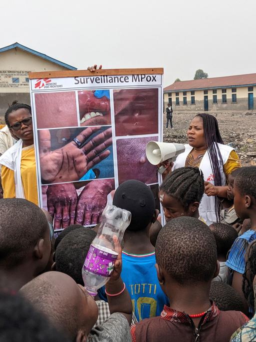 Das Foto zeigt Doctors Without Borders am 31.Mai 2023, Helfer die Menschen aufklären über Mpox in Goma, Congo. (Augustin Mudiayi/Doctors Without Borders/MÃ©decins Sans FrontiÃ¨res via AP)